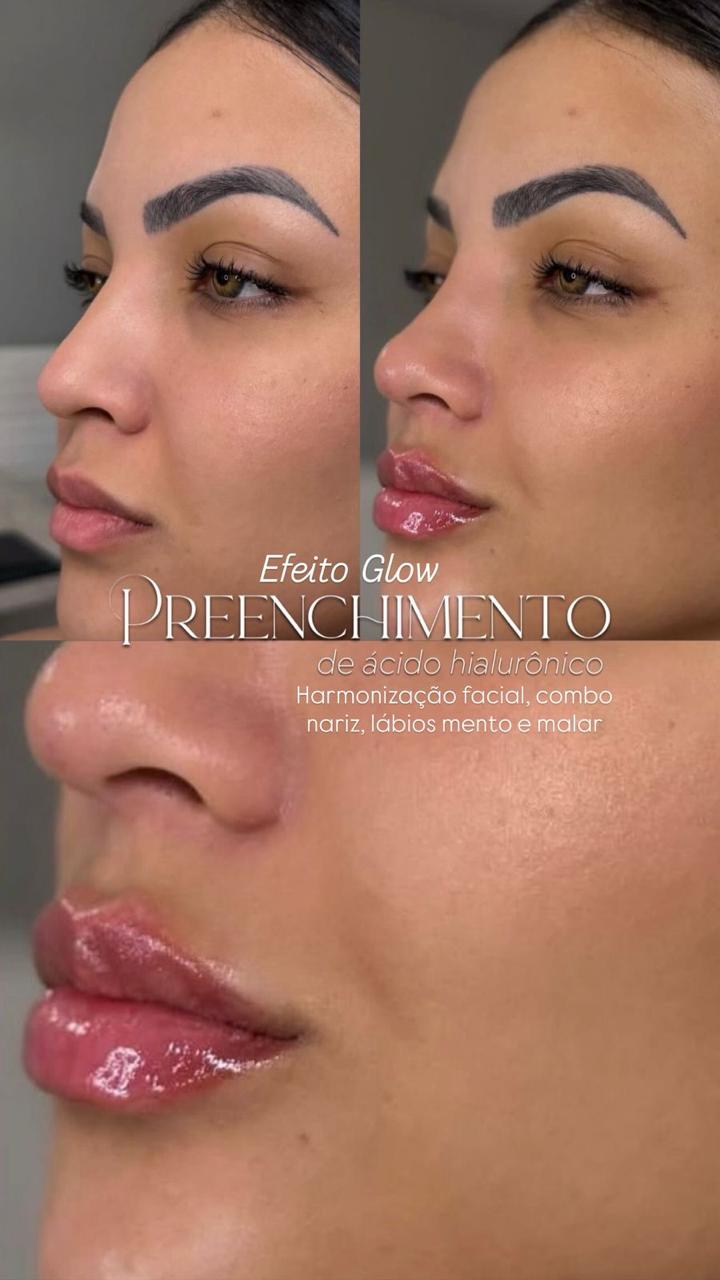Harmonização facial — antes e depois