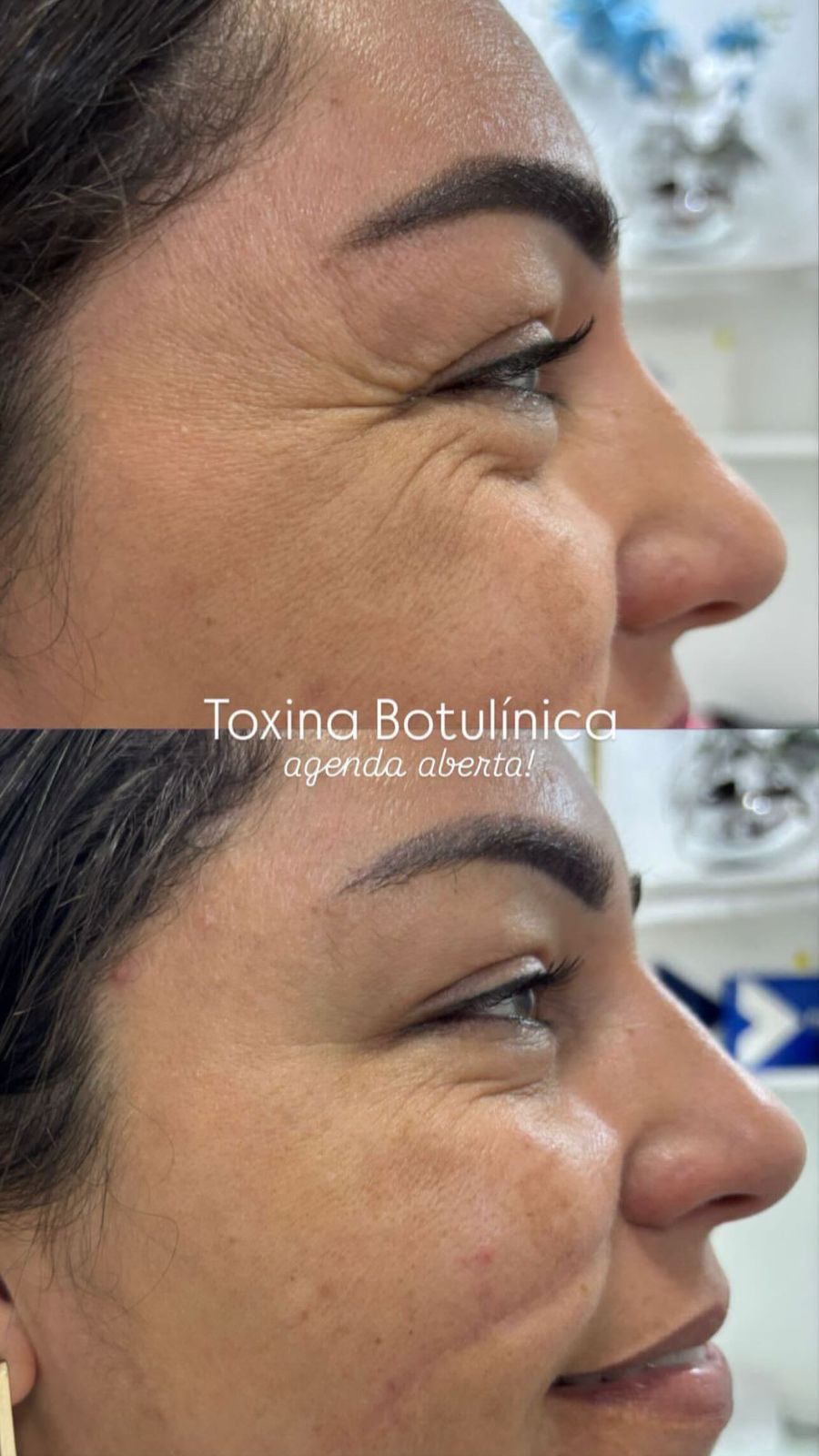 Toxina botulínica — antes e depois