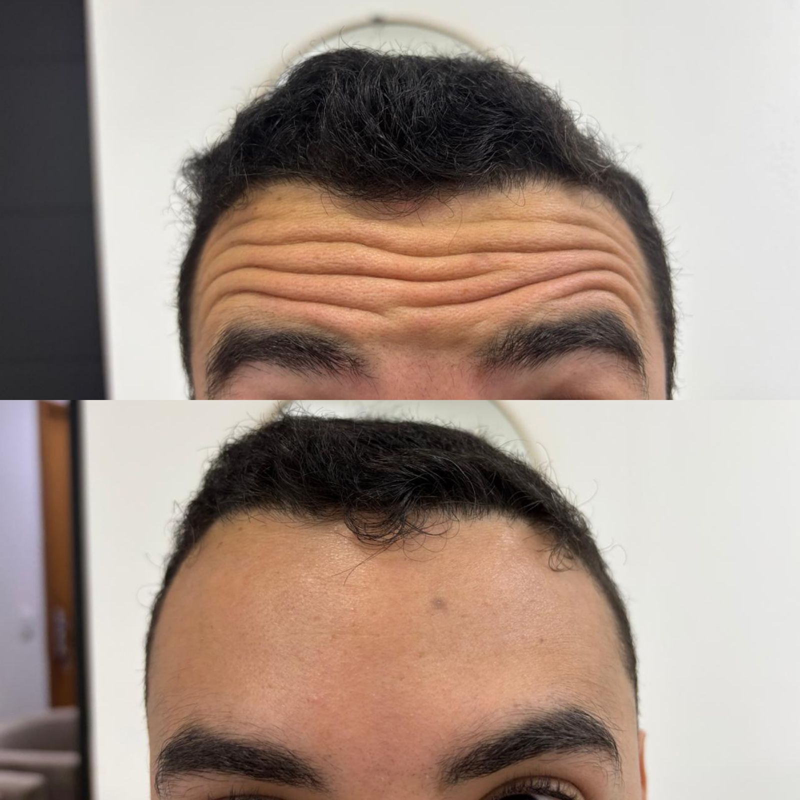 Toxina botulínica — antes e depois