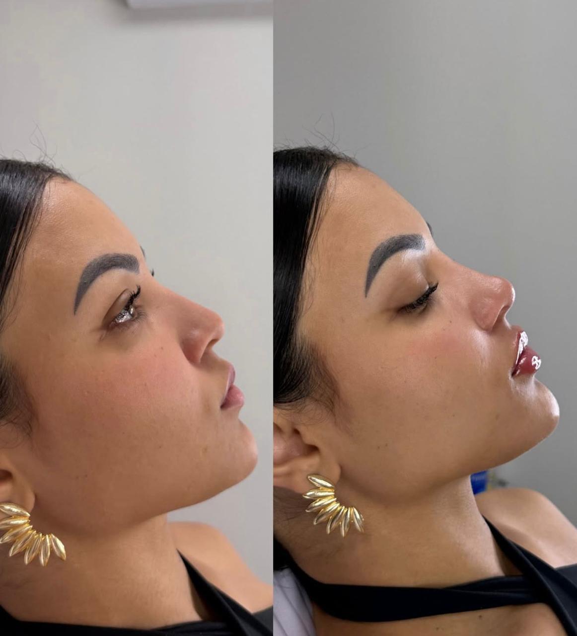 Preenchimento labial — antes e depois